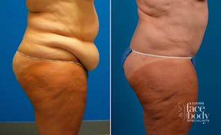 Hidden Tummy Tuck Before & After Gallery - Patient 173773 - Image 2