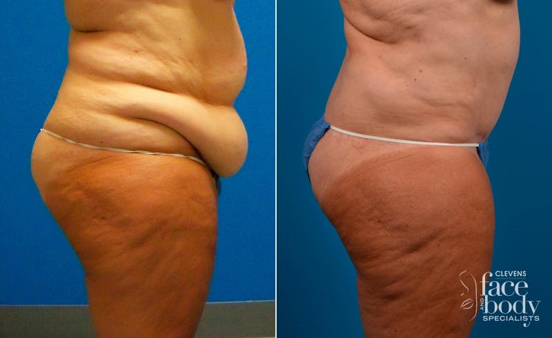 Hidden Tummy Tuck Before & After Gallery - Patient 173773 - Image 2