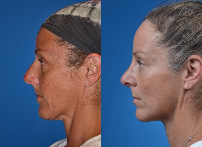 Rhinoplasty Before & After Gallery - Patient 122406764 - Image 1