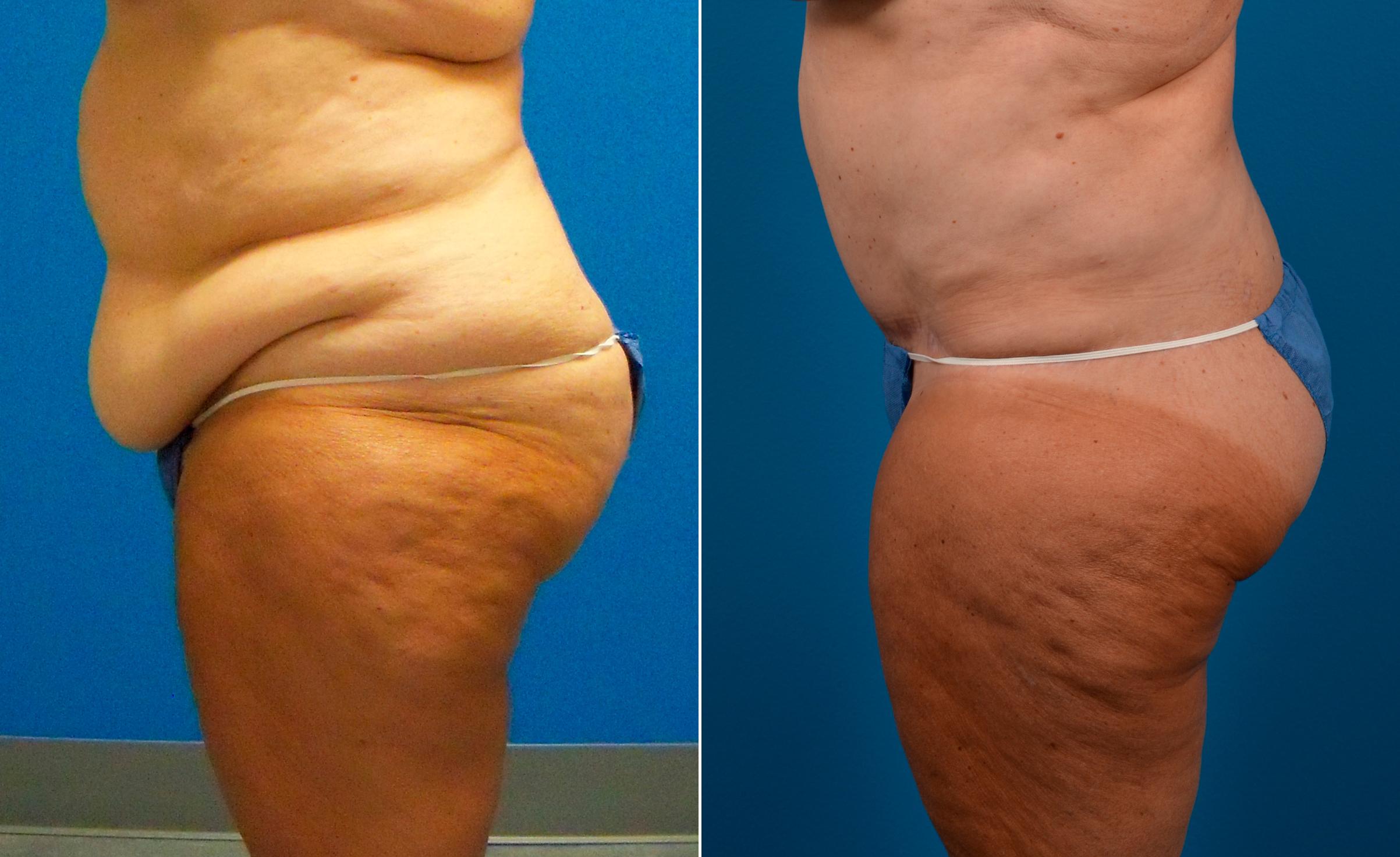 Hidden Tummy Tuck Before & After Gallery - Patient 173773 - Image 3