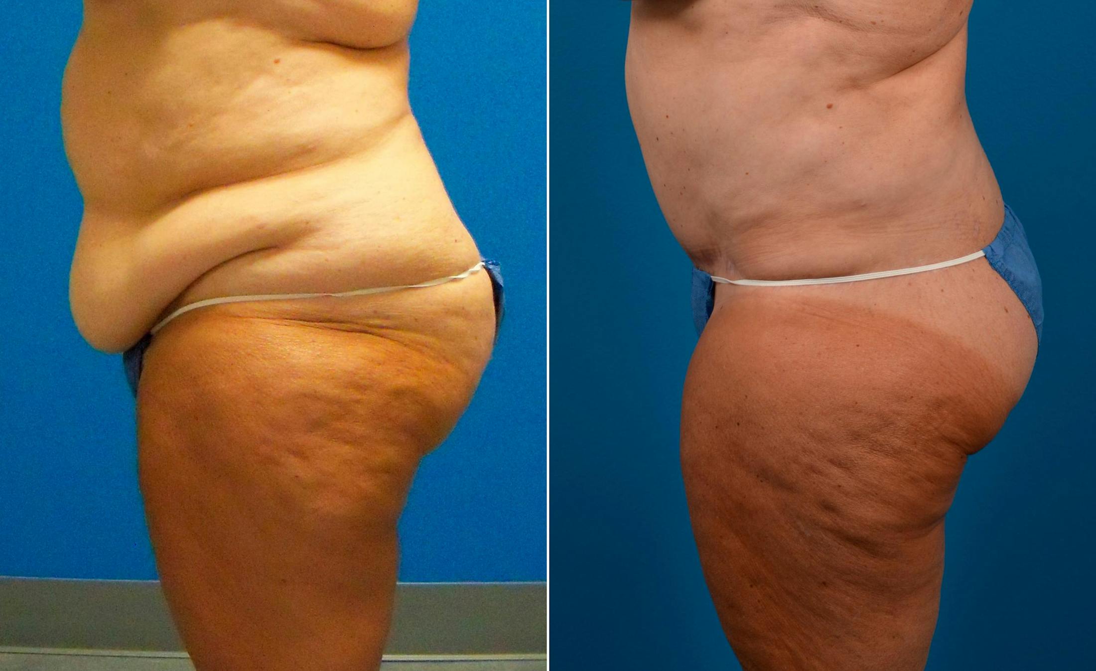 Tummy Tuck Before & After Gallery - Patient 122406766 - Image 3