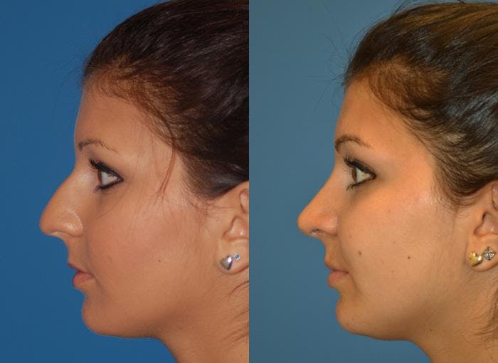 Rhinoplasty Before & After Gallery - Patient 122406767 - Image 1