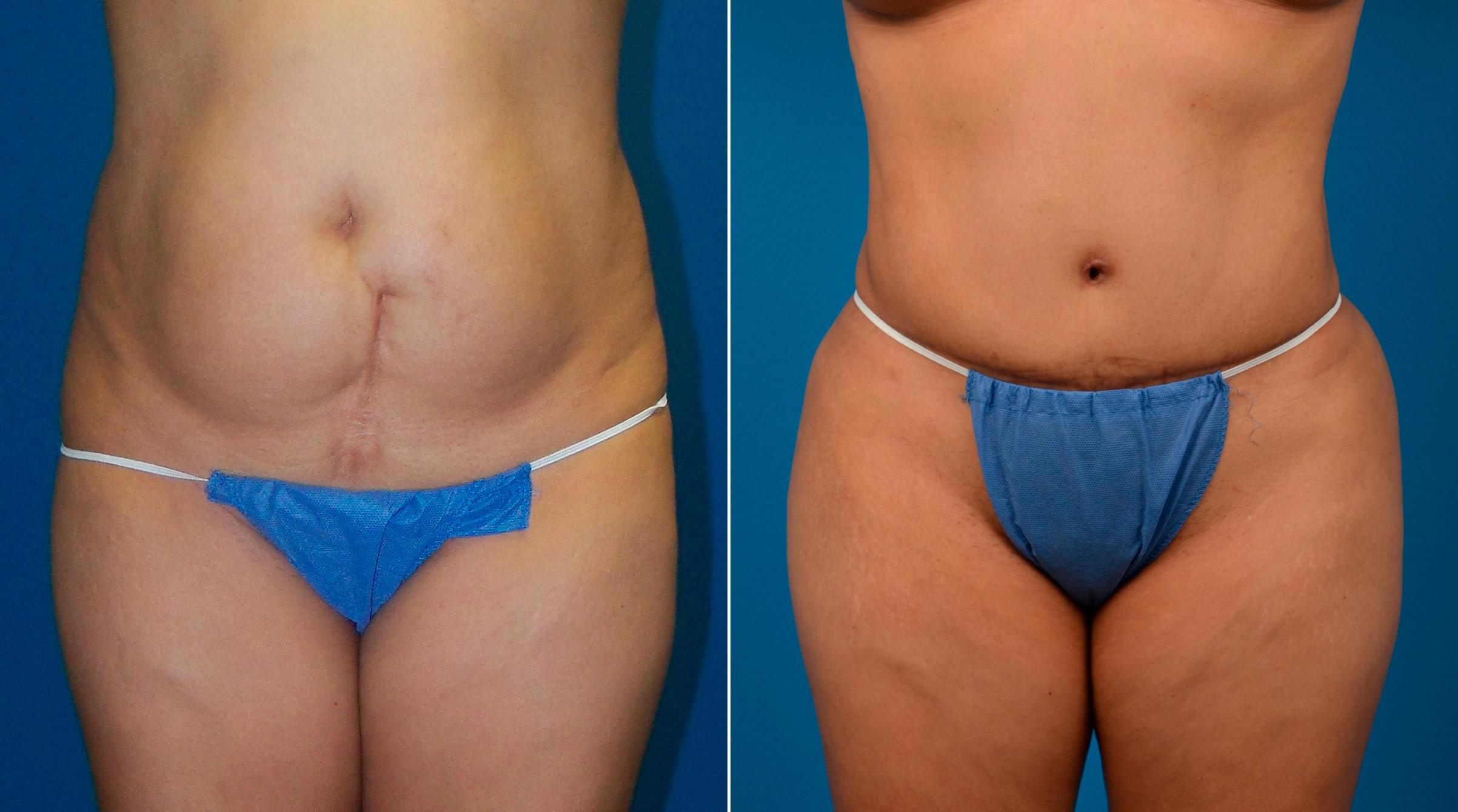 Hidden Tummy Tuck Before & After Gallery - Patient 713047 - Image 1
