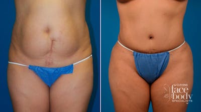 Hidden Tummy Tuck Before & After Gallery - Patient 713047 - Image 1