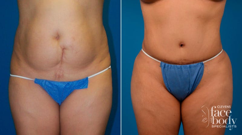 Hidden Tummy Tuck Before & After Gallery - Patient 713047 - Image 1