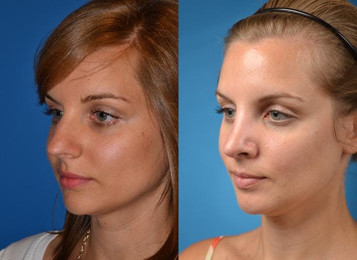 Rhinoplasty Before & After Gallery - Patient 122406770 - Image 1