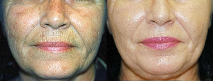 Skin Resurfacing Before & After Gallery - Patient 122406769 - Image 1