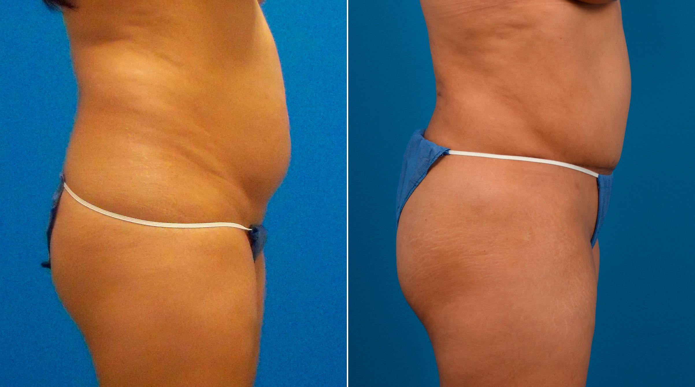 Hidden Tummy Tuck Before & After Gallery - Patient 713047 - Image 2