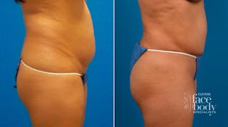 Hidden Tummy Tuck Before & After Gallery - Patient 713047 - Image 2