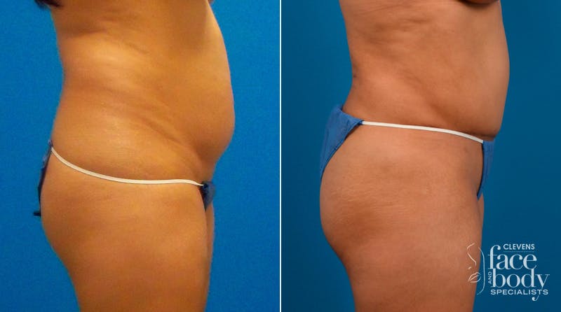 Hidden Tummy Tuck Before & After Gallery - Patient 713047 - Image 2