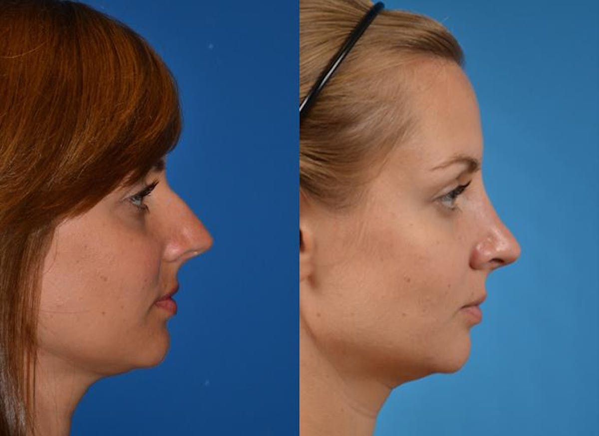 Rhinoplasty Before & After Gallery - Patient 122406770 - Image 2