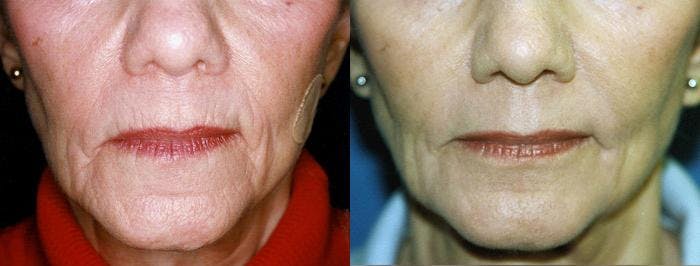 Skin Resurfacing Before & After Gallery - Patient 122406771 - Image 1