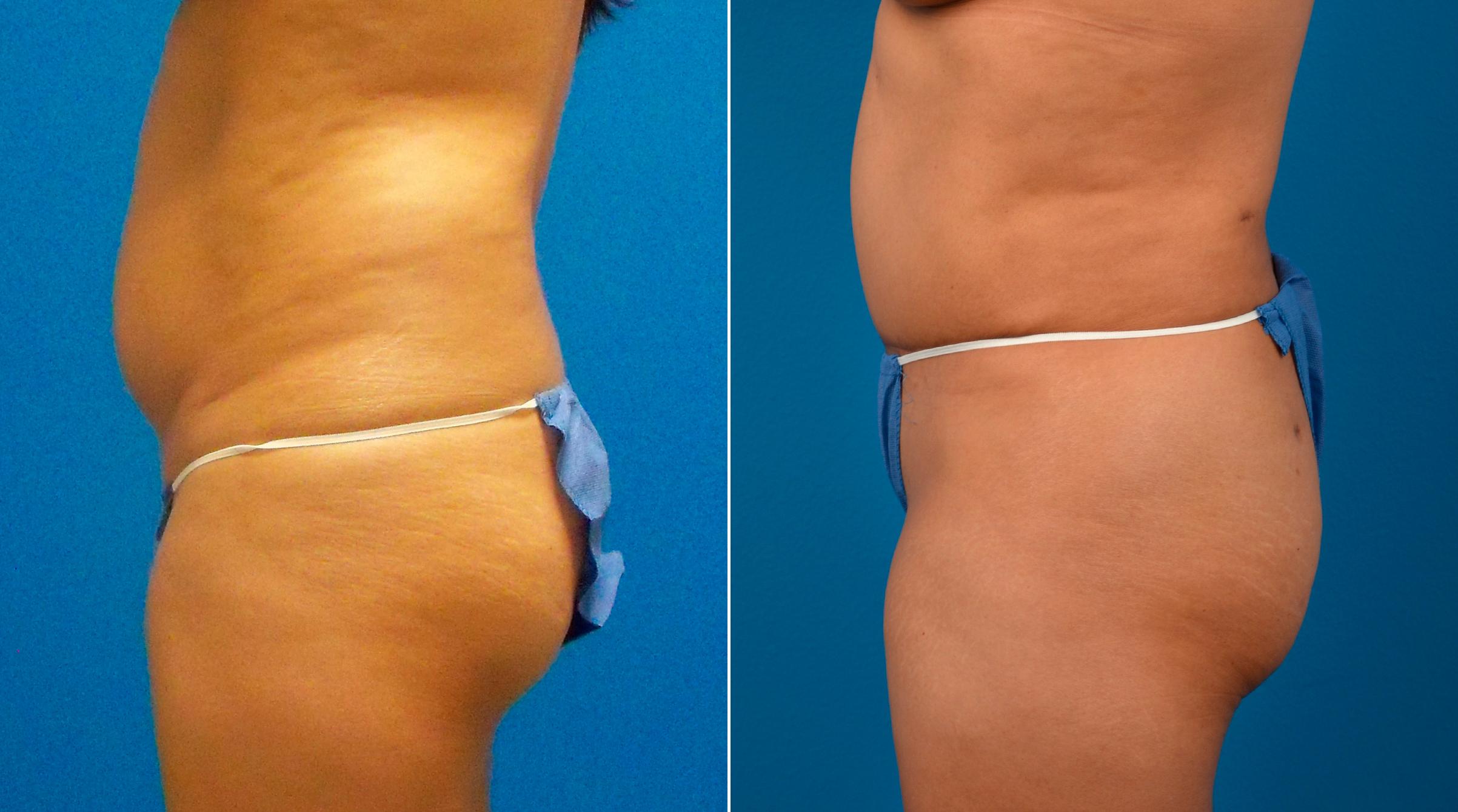 Hidden Tummy Tuck Before & After Gallery - Patient 713047 - Image 3