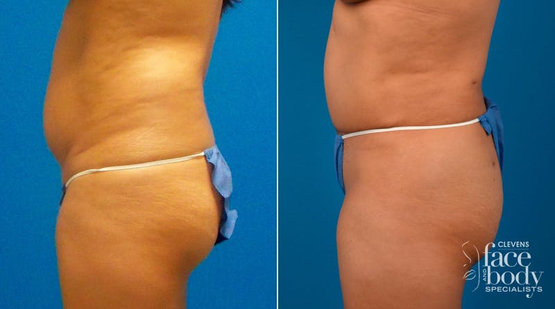 Hidden Tummy Tuck Before & After Gallery - Patient 713047 - Image 3