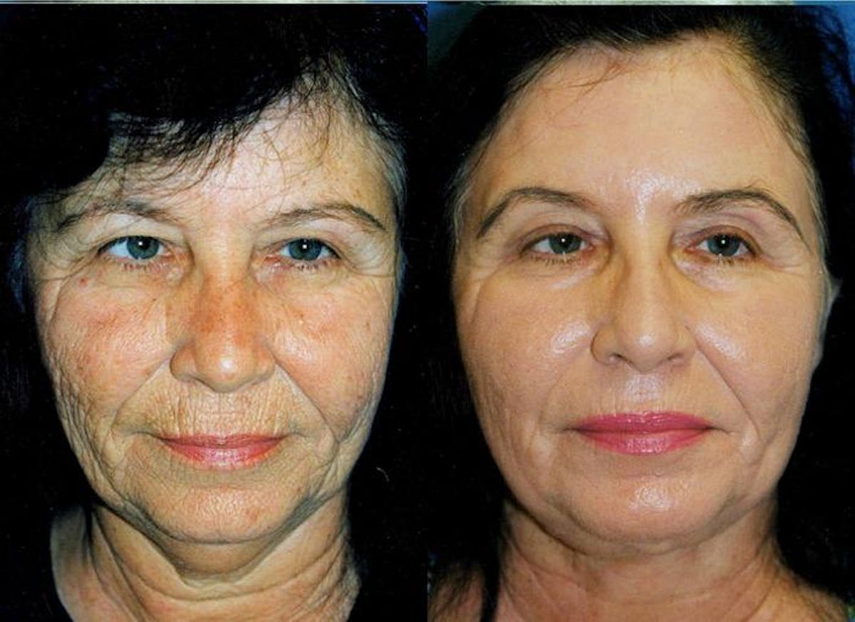 Skin Resurfacing Before & After Gallery - Patient 122406774 - Image 1