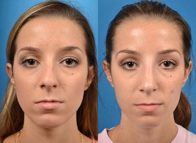 Rhinoplasty Before & After Gallery - Patient 122406776 - Image 1