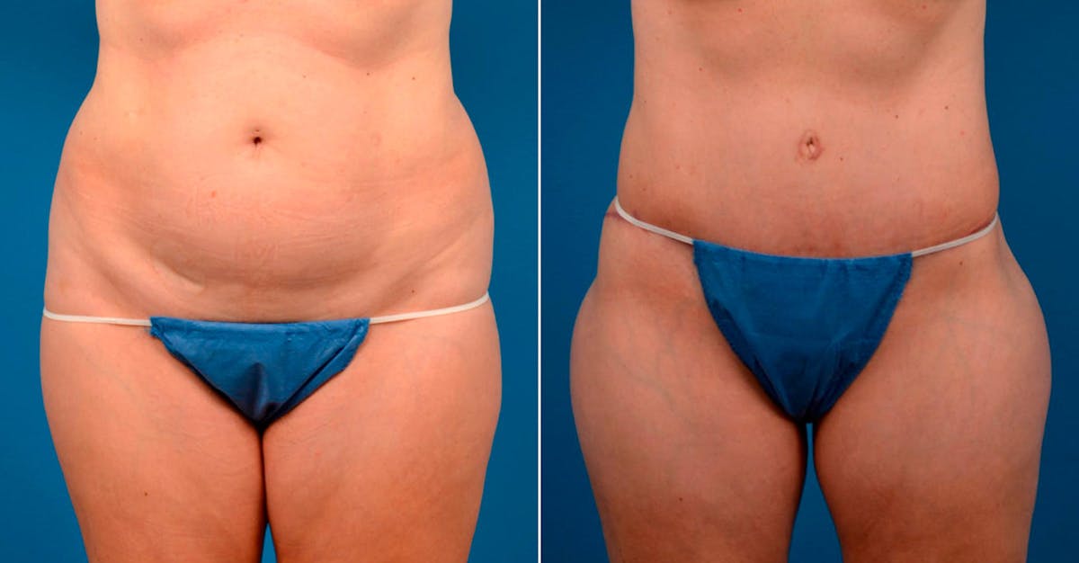 Tummy Tuck Before & After Gallery - Patient 196093 - Image 1