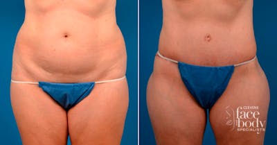 Hidden Tummy Tuck Before & After Gallery - Patient 171814 - Image 1