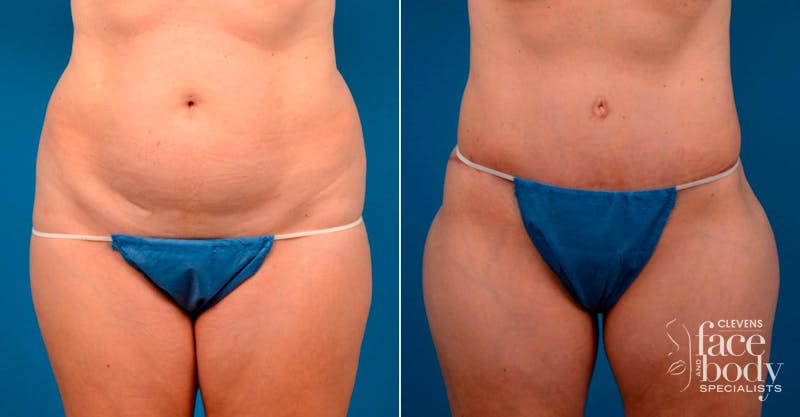 Hidden Tummy Tuck Before & After Gallery - Patient 171814 - Image 1