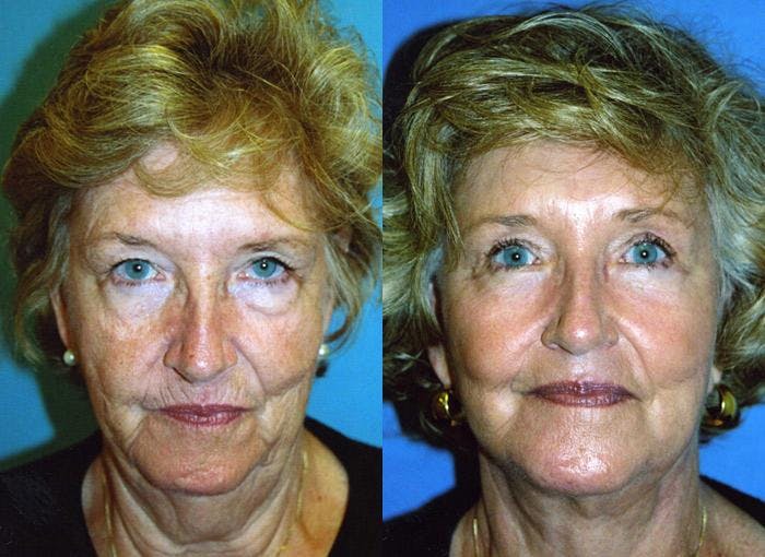 Skin Resurfacing Before & After Gallery - Patient 122406775 - Image 1