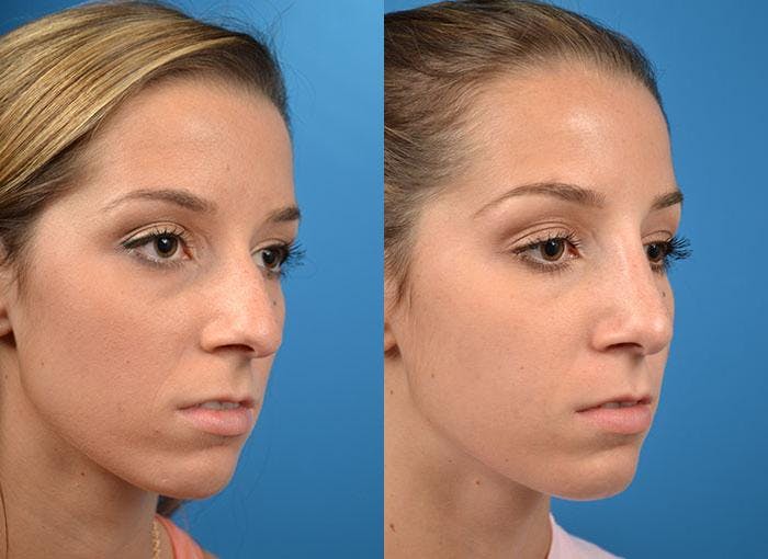 Rhinoplasty Before & After Gallery - Patient 122406776 - Image 2