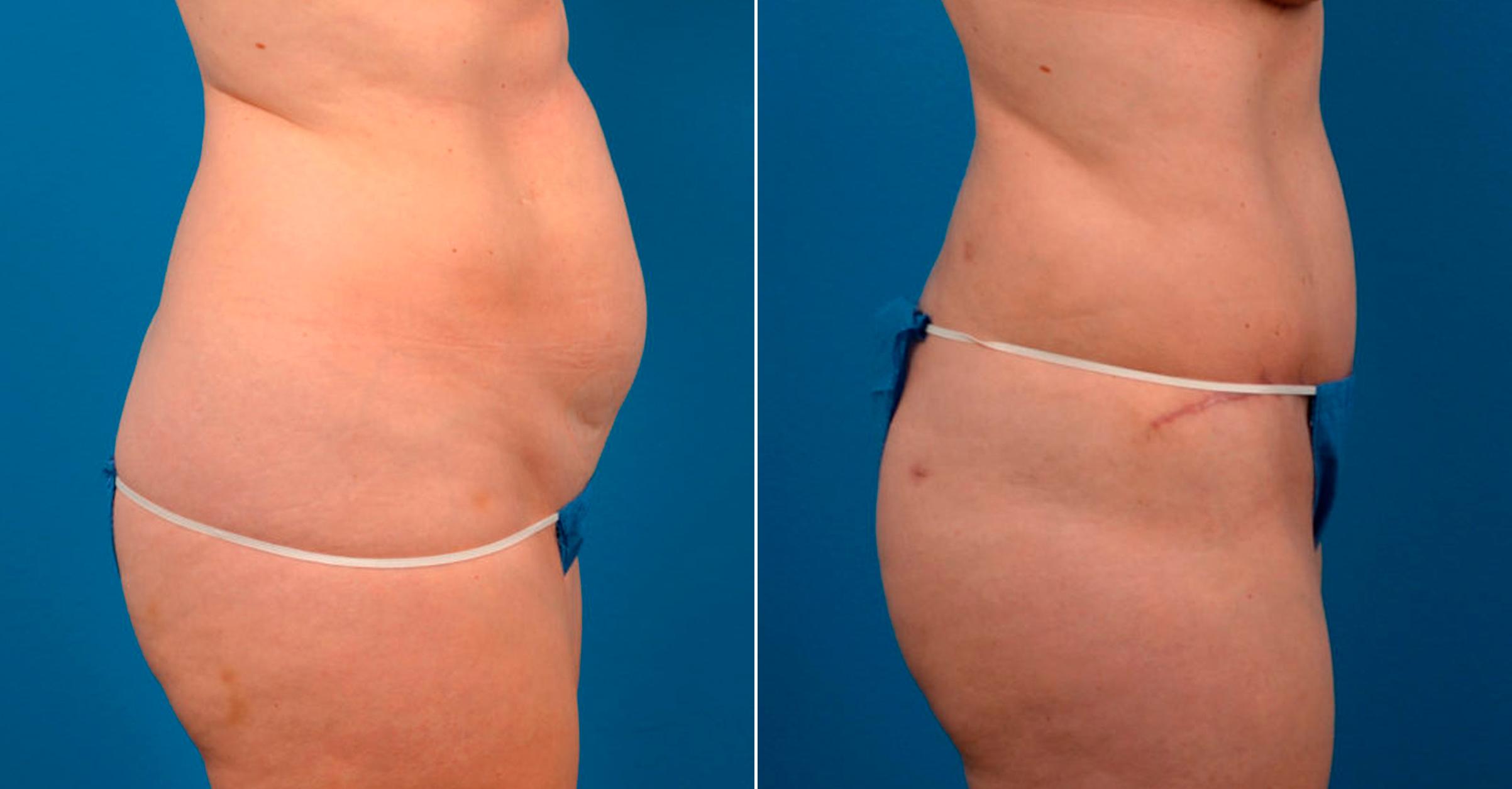 Hidden Tummy Tuck Before & After Gallery - Patient 171814 - Image 2