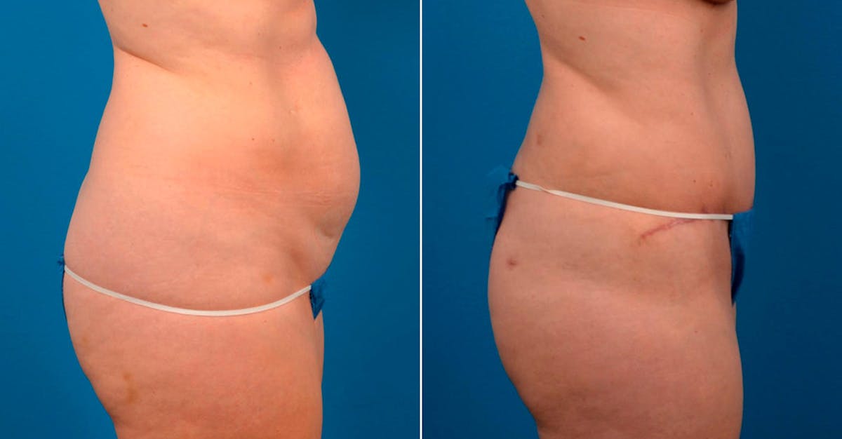 Tummy Tuck Before & After Gallery - Patient 196093 - Image 2
