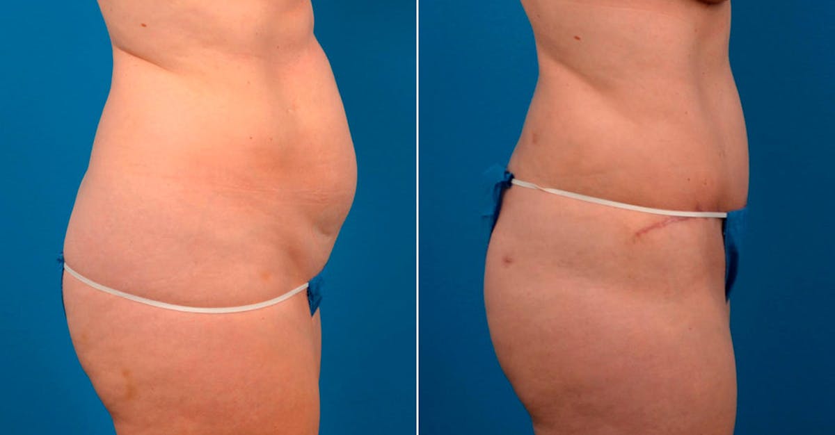 Hidden Tummy Tuck Before & After Gallery - Patient 171814 - Image 2