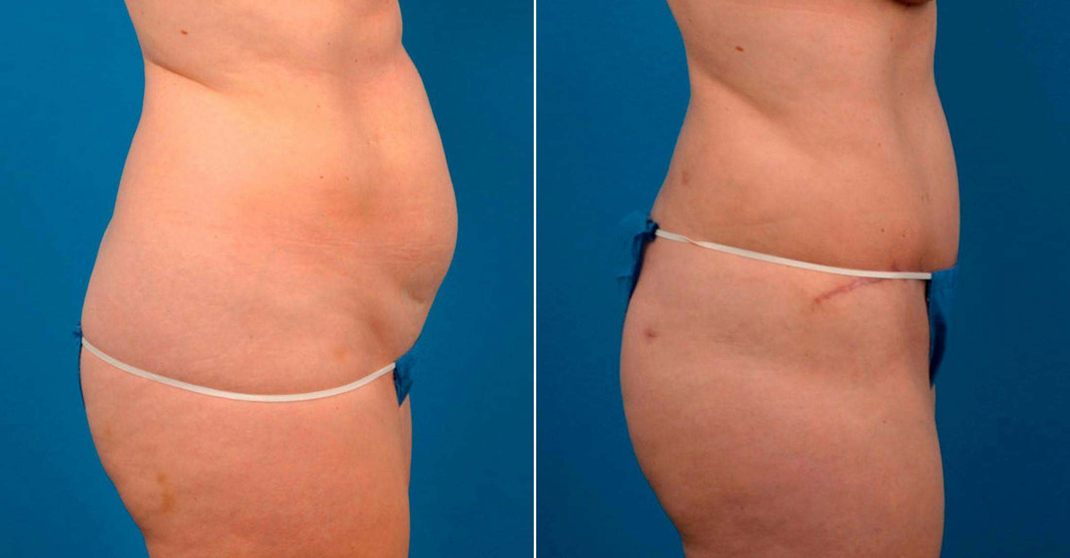 Tummy Tuck Before & After Gallery - Patient 122406777 - Image 2