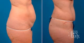 Hidden Tummy Tuck Before & After Gallery - Patient 171814 - Image 2