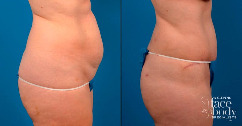 Hidden Tummy Tuck Before & After Gallery - Patient 171814 - Image 2