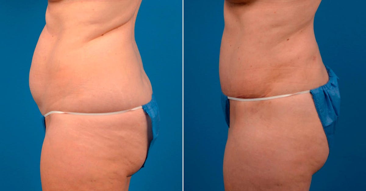 Tummy Tuck Before & After Gallery - Patient 196093 - Image 3