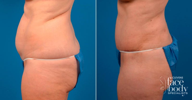 Hidden Tummy Tuck Before & After Gallery - Patient 171814 - Image 3