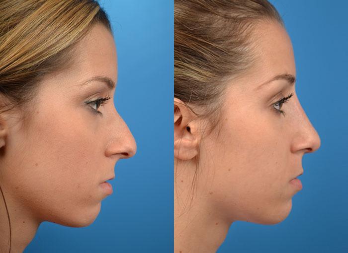 Rhinoplasty Before & After Gallery - Patient 122406776 - Image 3
