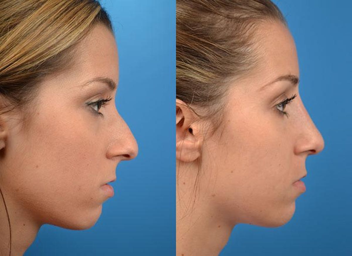 Rhinoplasty Before & After Gallery - Patient 122406776 - Image 3