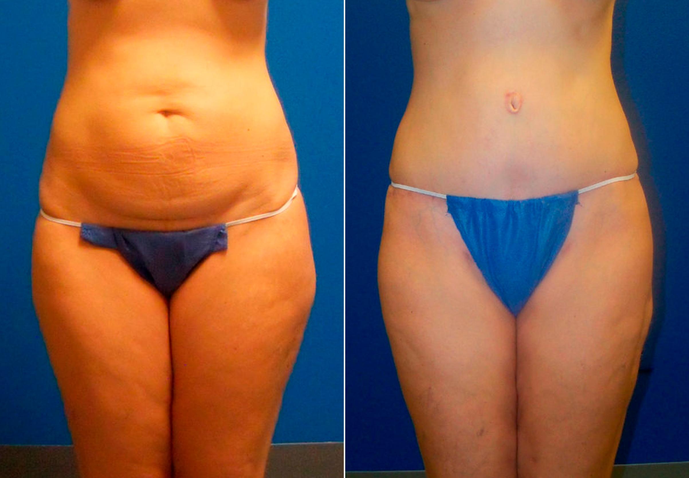 Hidden Tummy Tuck Before & After Gallery - Patient 349076 - Image 1