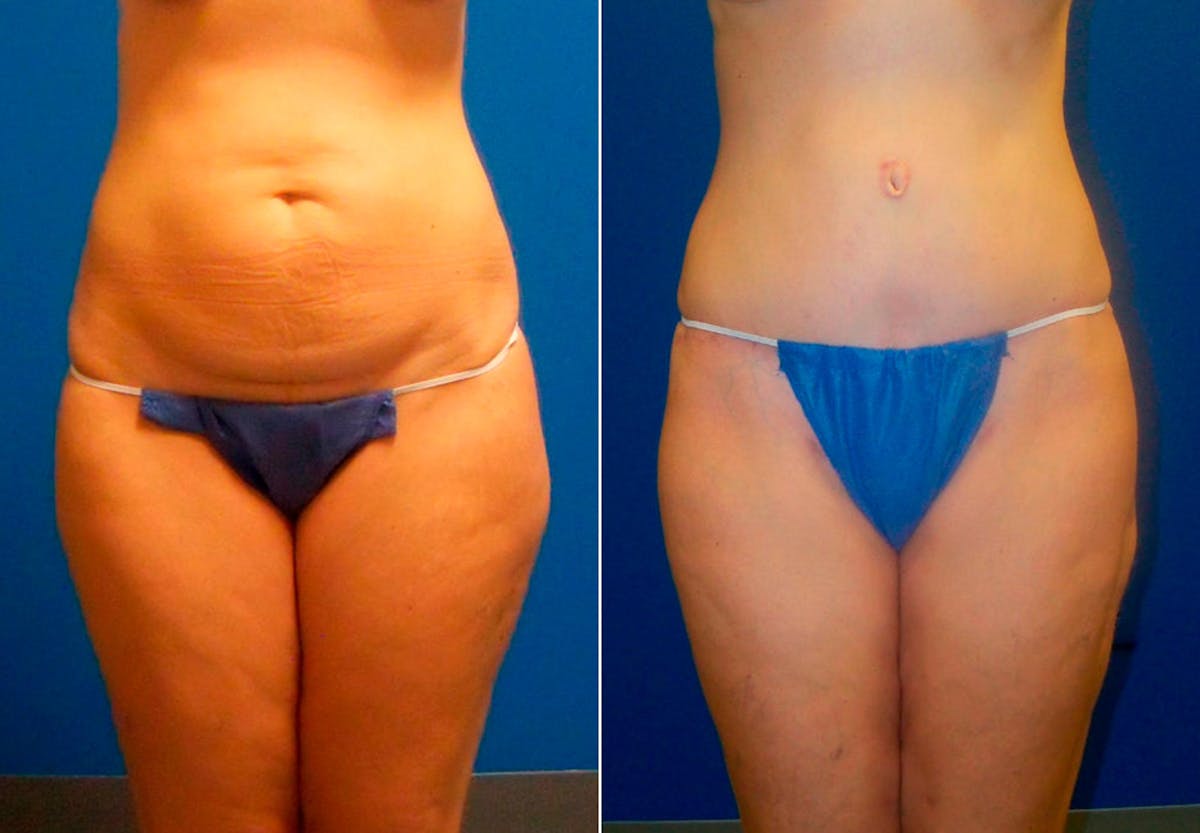 Hidden Tummy Tuck Before & After Gallery - Patient 349076 - Image 1