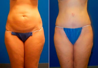 Hidden Tummy Tuck Before & After Gallery - Patient 349076 - Image 1