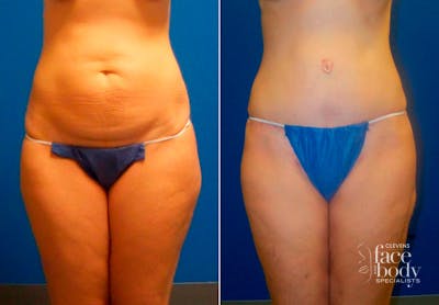 Hidden Tummy Tuck Before & After Gallery - Patient 349076 - Image 1