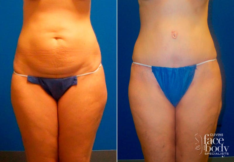 Hidden Tummy Tuck Before & After Gallery - Patient 349076 - Image 1