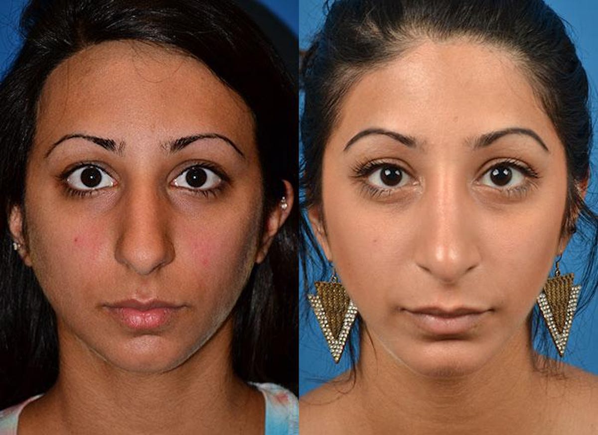 Rhinoplasty Before & After Gallery - Patient 122406779 - Image 1