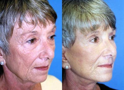 Skin Resurfacing Before & After Gallery - Patient 122406780 - Image 1