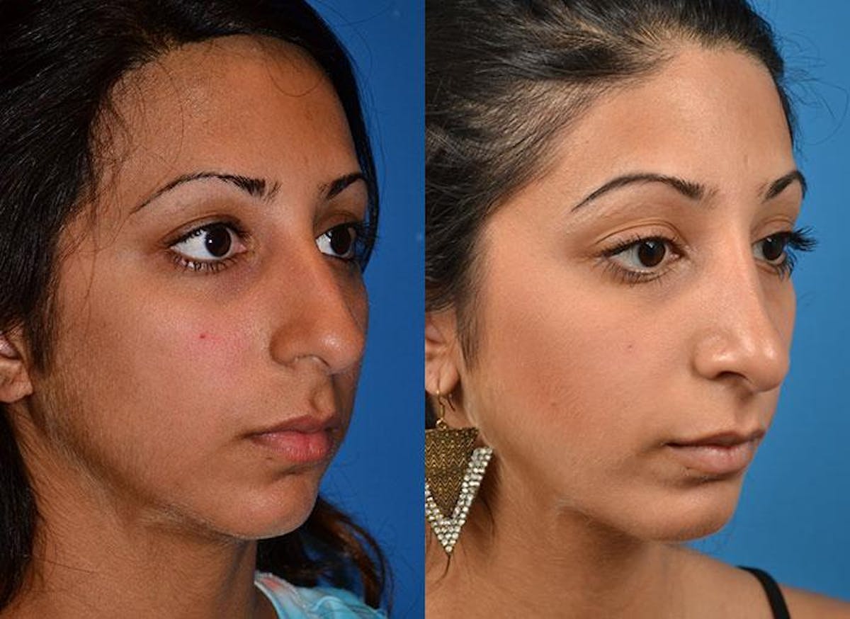 Rhinoplasty Before & After Gallery - Patient 122406779 - Image 2