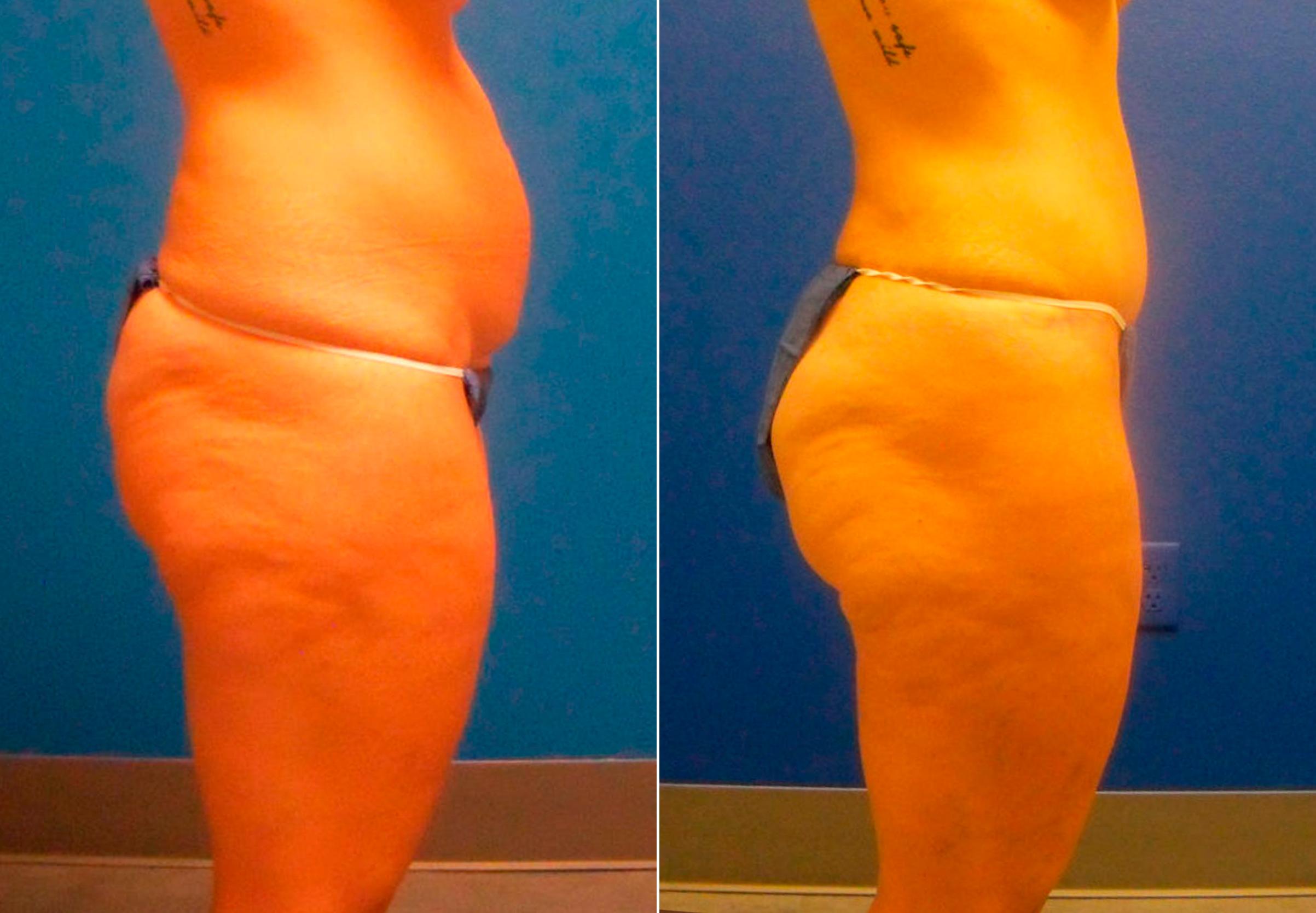 Hidden Tummy Tuck Before & After Gallery - Patient 349076 - Image 2