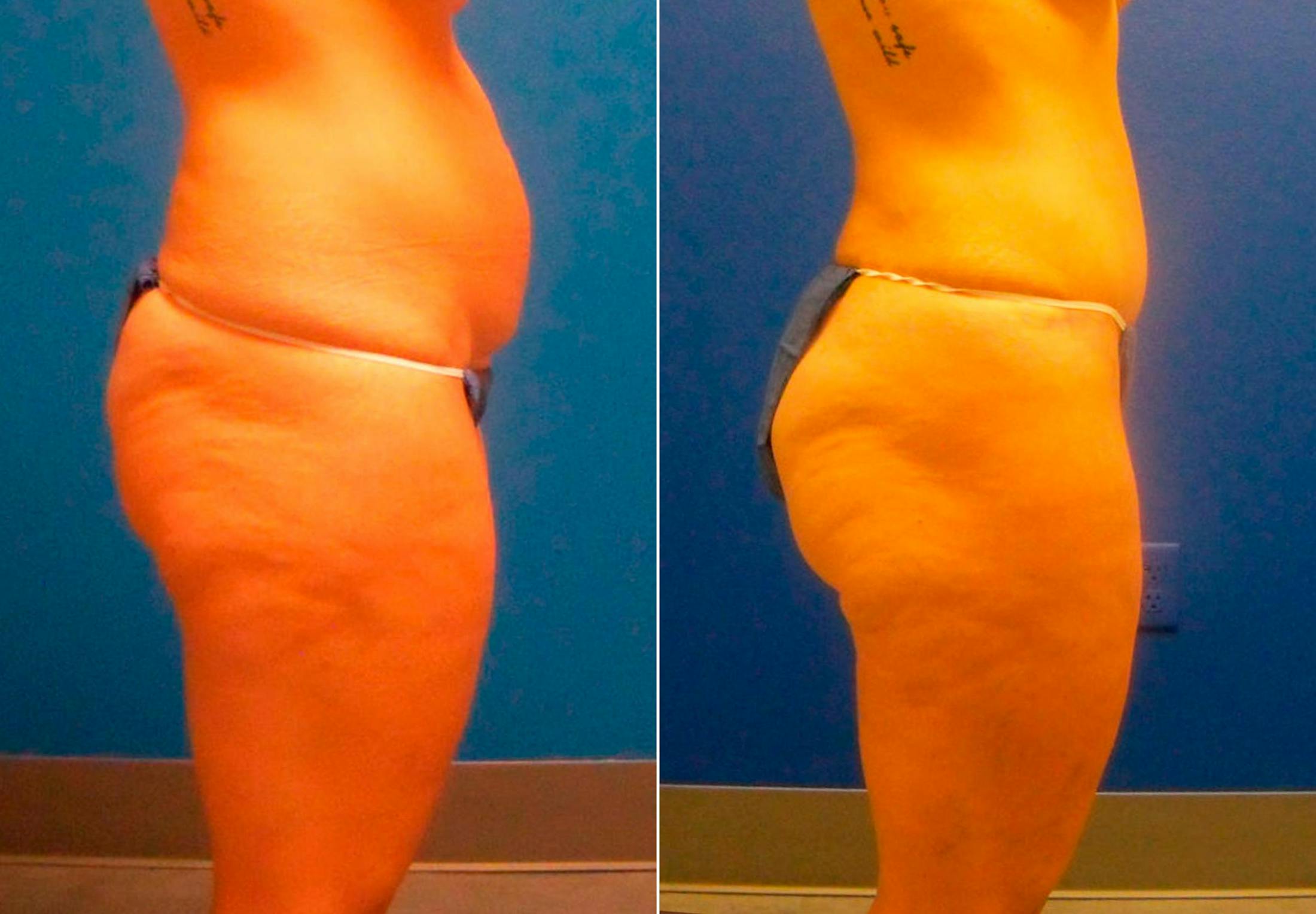 Tummy Tuck Before & After Gallery - Patient 122406781 - Image 2
