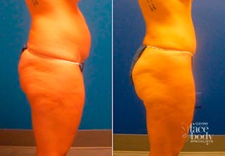 Hidden Tummy Tuck Before & After Gallery - Patient 349076 - Image 2
