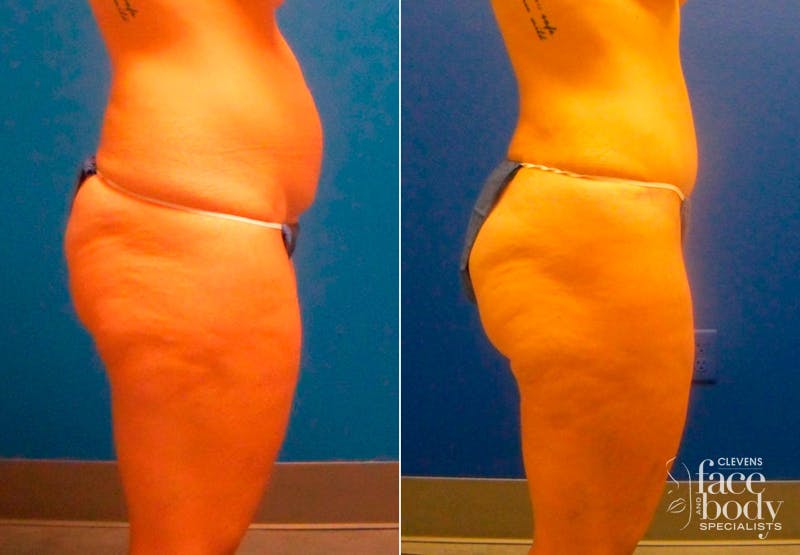 Hidden Tummy Tuck Before & After Gallery - Patient 349076 - Image 2