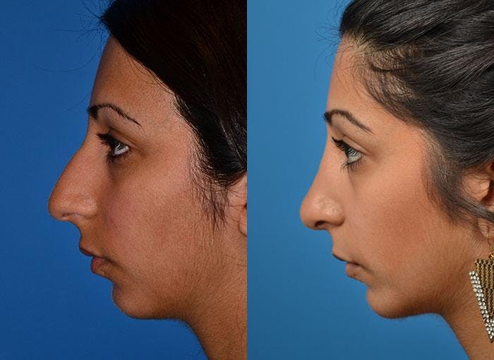 Rhinoplasty Before & After Gallery - Patient 122406779 - Image 3