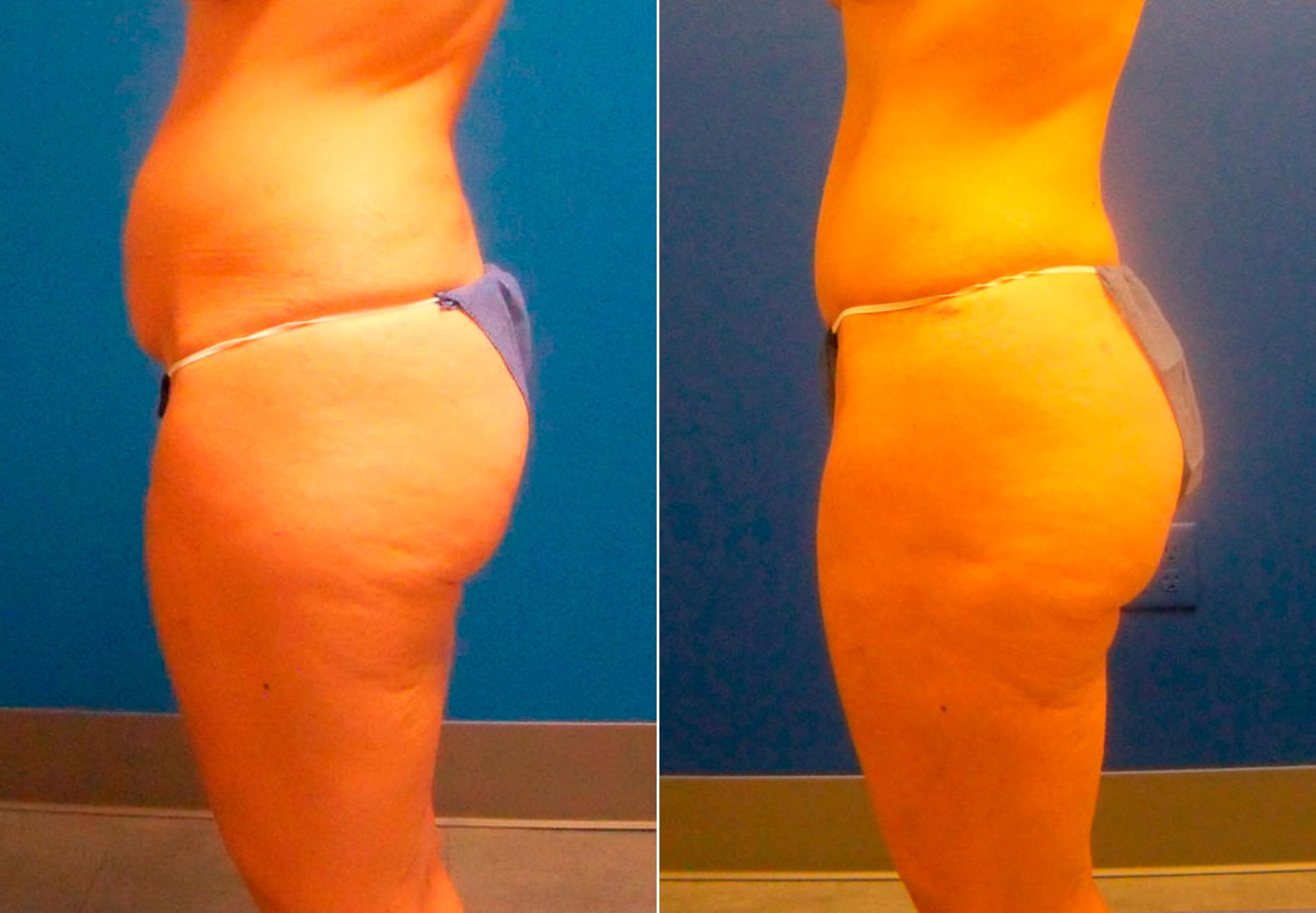 Hidden Tummy Tuck Before & After Gallery - Patient 349076 - Image 3
