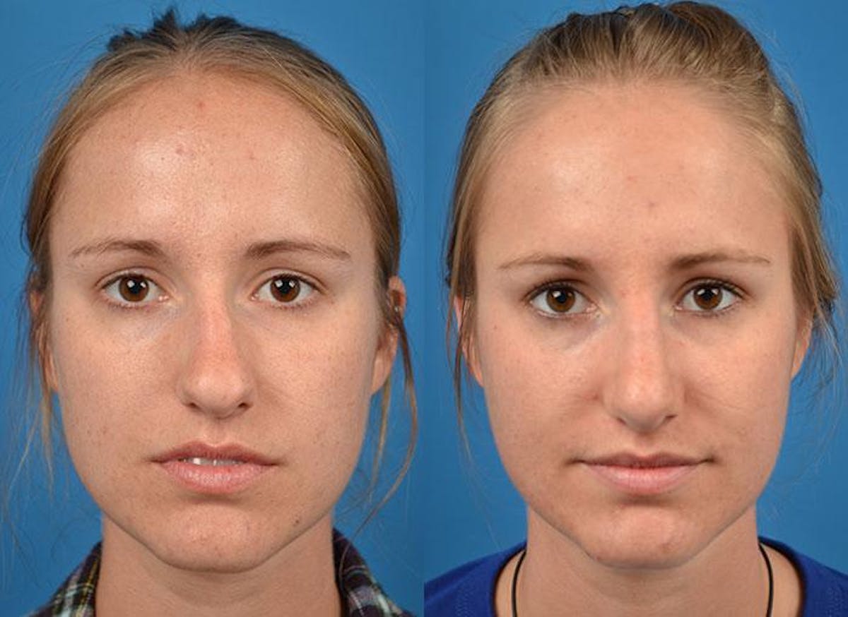 Rhinoplasty Before & After Gallery - Patient 122406782 - Image 1